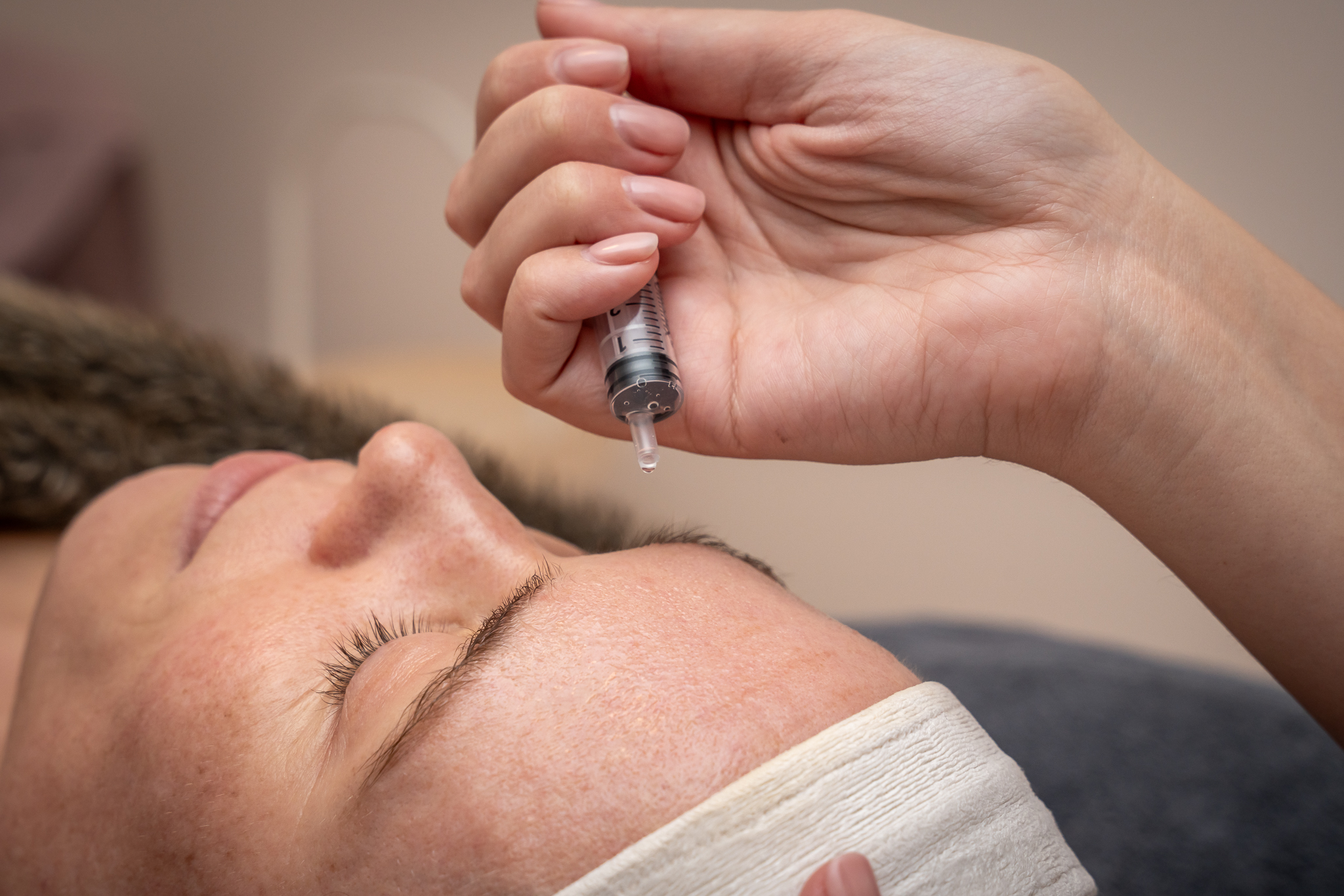 chemische peel